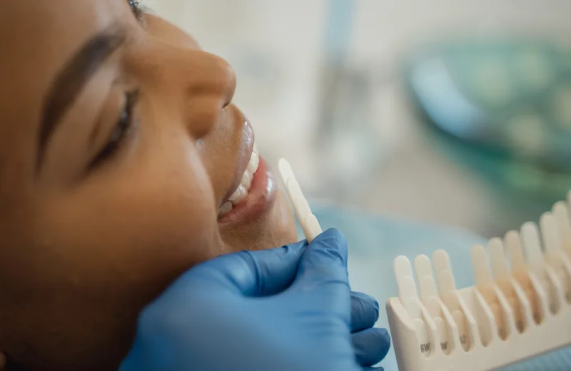 Cuidados após o clareamento dental (imagem ilustrativa)