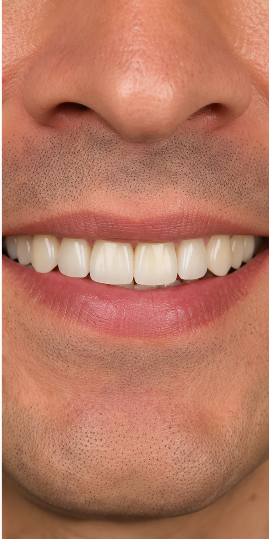 Depois do implante dentário (imagem ilustrativa)